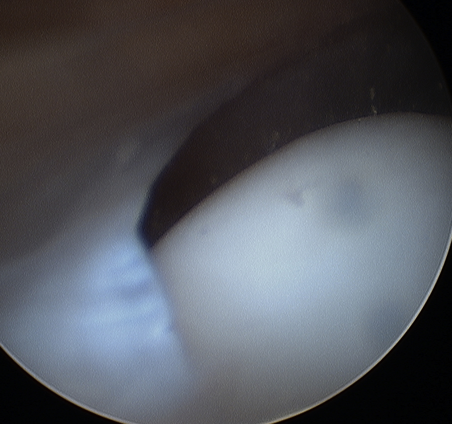 Medial Plica Asymptomatic Thin